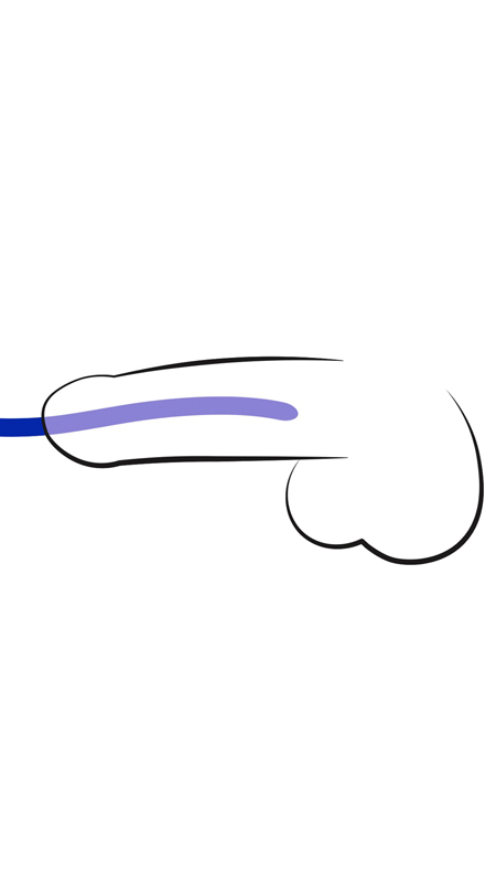 dilator2.jpg